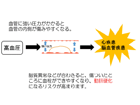 高血圧になると血管の内側が傷みやすくなり脂質異常と合わさると血栓ができ、心疾患、脳血管疾患になる図